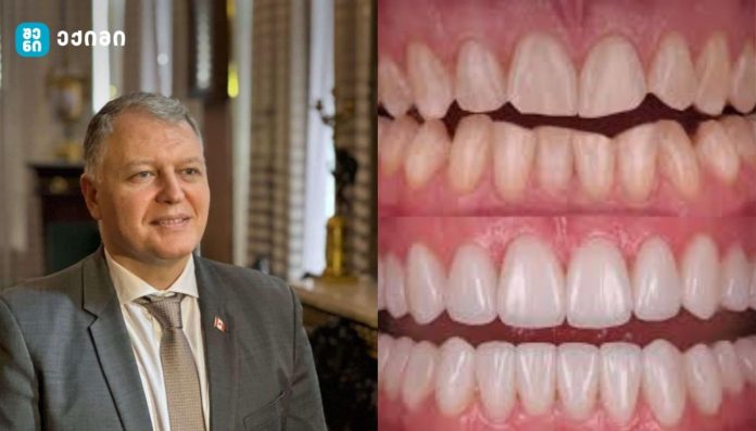 რა საერთო აქვთ კარიესს და გულის შეტევას? – კბილების გაფუჭება გულს აზიანებს — და შეიძლება სიცოცხლისთვის საფრთხეც იყოს