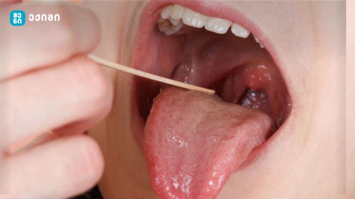 ტონზილექტომია და პოსტოპერაციული სისხლდენა: რა უნდა იცოდეთ გლანდების ამოკვეთის შემდეგ