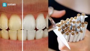 ლამაზი ღიმილისთვის კბილების გამოხეხვა არ კმარა – შეგრძნებები და სიმპტომები, რომლებიც სიგარეტზე თავის დანებების საწყის ეტაპზე იჩენს თავს