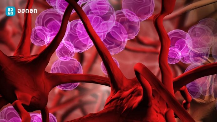 როგორ უნდა გაიგოთ, გაქვთ თუ არა რკინადეფიციტური ანემია