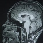 კვლევა – სიმსუქნე და ტვინი – სიმსუქნე შესაძლოა, თავის ტვინის ზომის შემცირებას იწვევდეს