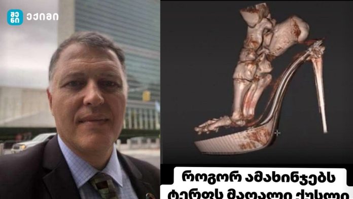 შედეგი შოკისმომგვრელია – როგორ ამახინჯებს ტერფს მაღალი ქუსლი