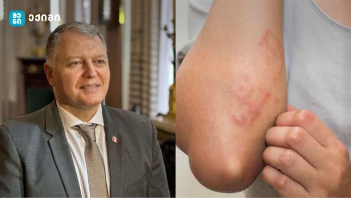 მომრავლდა მუნის შემთხვევები – „მუნის წამალი ქვეყანაში არ არის!!!“ – გიორგი ფხაკაძე