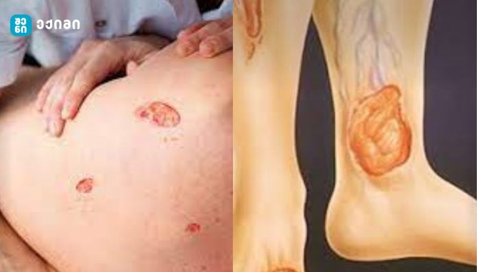 ნაწოლები – როგორ ავიცილოთ თავიდან და როგორ მოვუაროთ?