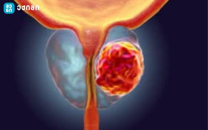 პრეპარატი, რომელსაც შეუძლია პროსტატის კიბოს ზრდის შეჩერება მისი გენეტიკური მექანიზმების ბლოკირებით – პროსტატის კიბოს გენების „გამორთვის“ გზა