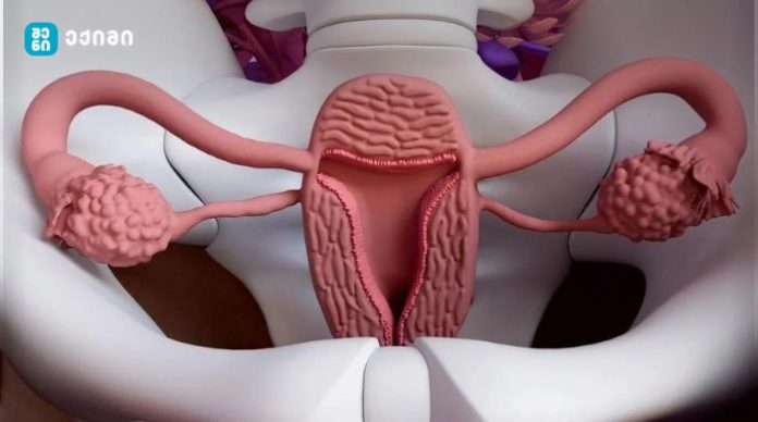 რეკომენდაციები – რა უნდა გააკეთოთ საშვილოსნოს ამოკვეთის შემდეგ