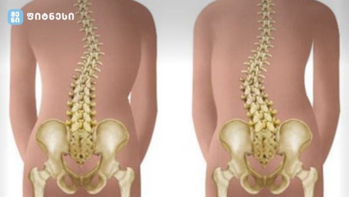 სქოლიოზი ეს არის ხერხემლის სვეტის კომპლექსური, სამგანზომილებიანი დეფორმაცია, რომელიც შესაძლოა გამოვლინდეს ჯანმრთელ ბავშვებში