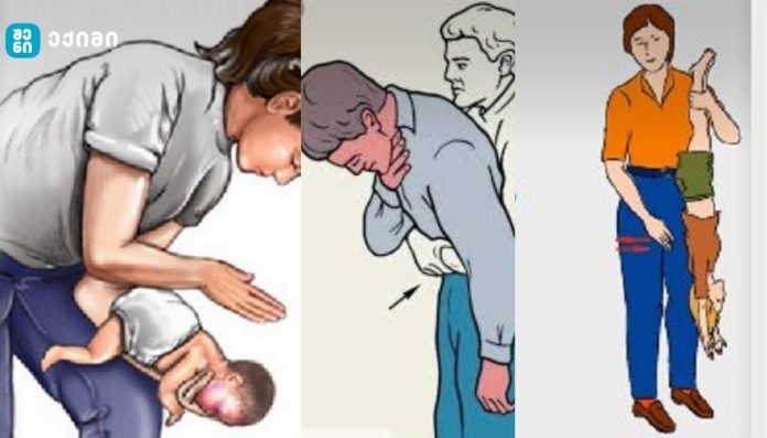 საკვების ან სხვა საგნების გადაცდენა – რა უნდა ვაკეთოთ, თუ ვინმეს უცხო სხეული გადასცდა