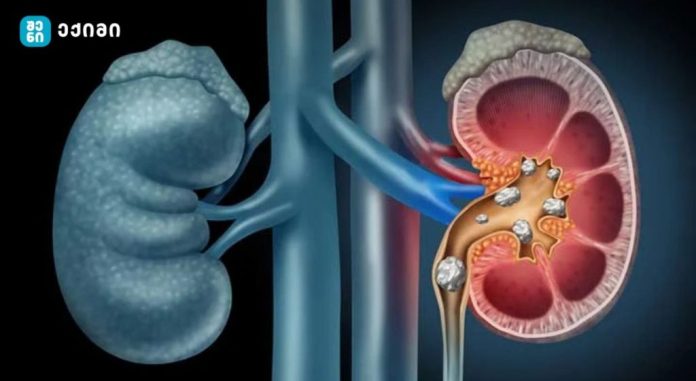 თუ შეამჩნევთ ამ სიმპტომებს, დაუყოვნებლივ შეიმოწმეთ თირკმელები!