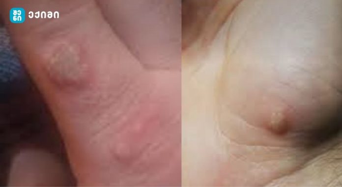 რა არის მეჭეჭი, რა იწვევს მას და როგორ ვუმკურნალოთ