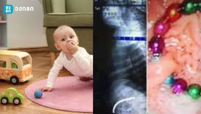 რა არის პირველი ნაბიჯი, თუ ეჭვი მაქვს, რომ ბავშვმა მაგნიტი ან ელემენტი გადაყლაპა? – შეიძლება ბავშვის სიცოცხლე საფრთხეში ჩააგდოს