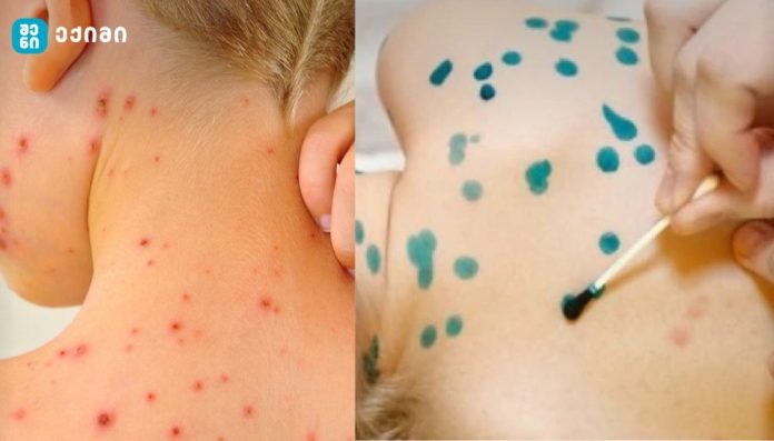 10 ყველაზე ეფექტური საშუალება ჩუტყვავილას სამკურნალოდ! მნიშვნელოვანი ინფორმაცია!