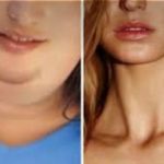 გსურთ მარტივად მოიცილოთ ღაბაბი