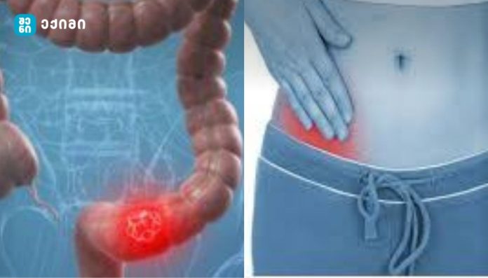 რა როლი აქვს რეალურად ბრმა ნაწლავს