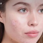 Close-up of a young woman's face with acne on her cheeks and a neutral expression.