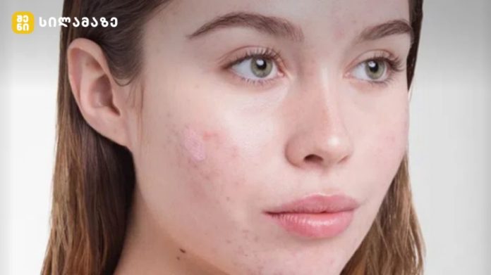 Close-up of a young woman's face with acne on her cheeks and a neutral expression.