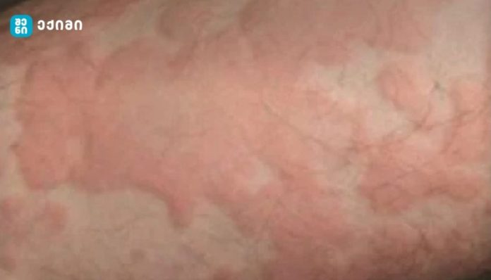 ურტიკარია (ჭინჭრის ციება) — ალერგიაა თუ რაღაც უფრო რთული?