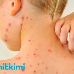 Close-up of a young person’s neck and upper back covered with red acne lesions; hand touching the skin; SheniKimi logo in corner.