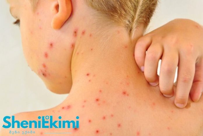 Close-up of a young person’s neck and upper back covered with red acne lesions; hand touching the skin; SheniKimi logo in corner.