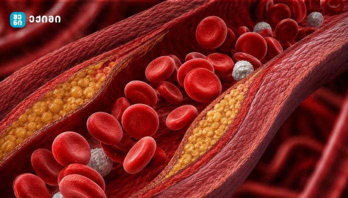 Cross-section of an artery with yellow fatty plaque and red blood cells, illustrating atherosclerosis in a blood vessel.