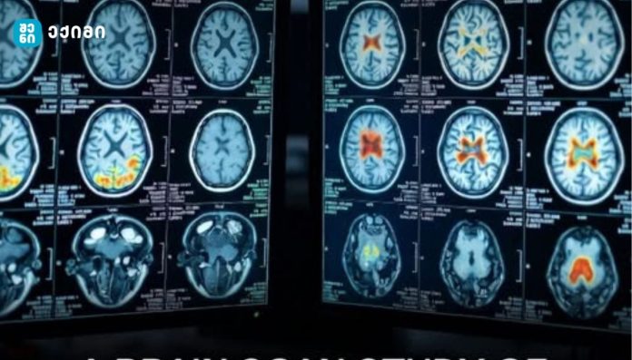 ADHD და ტვინი: მსოფლიოში ერთ-ერთმა ყველაზე დიდმა კვლევამ ნევროლოგიური განსხვავებების არსებობა დაადასტურა