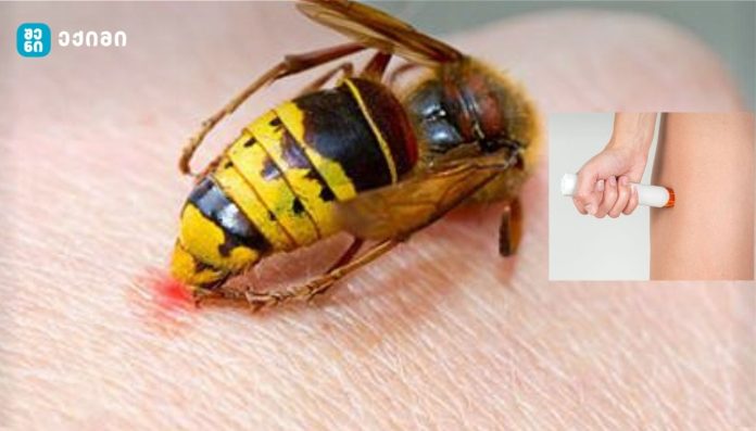 ყურადღებით წაიკითხეთ! - ბზიკის ნაკბენი და ანაფილაქსიური შოკი — როგორ ამოვიცნოთ სიცოცხლისთვის საშიში ალერგიული რეაქცია და როგორ მოვიქცეთ გადაუდებელ სიტუაციაში?