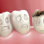 Row of molar teeth with cartoon faces looking worried, highlighting a tooth with a large cavity on the right.