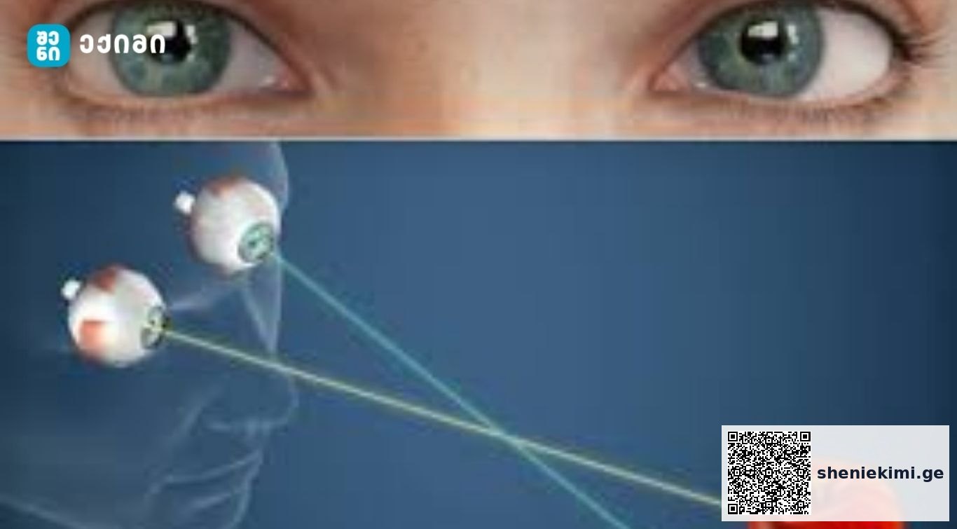 სიელმე (სტრაბიზმი)