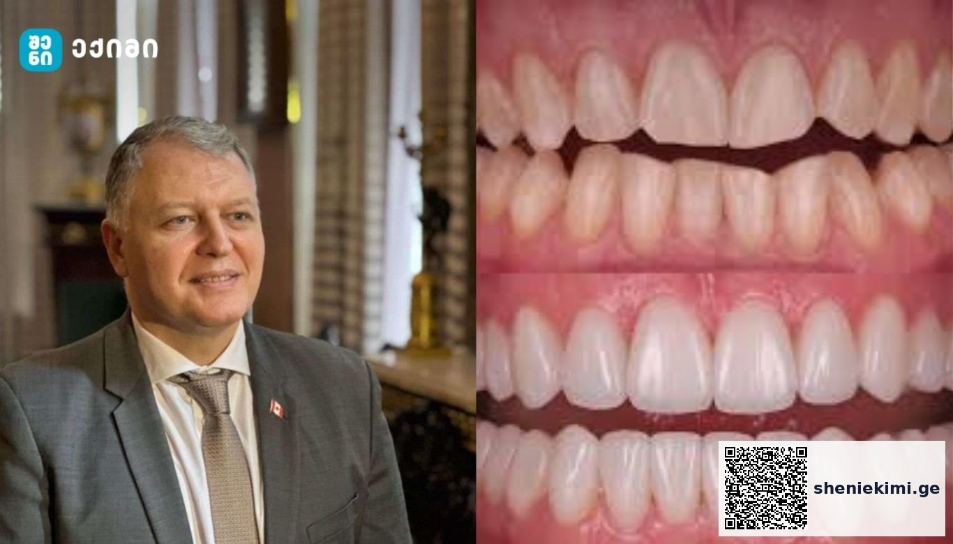 რა საერთო აქვთ კარიესს და გულის შეტევას? – კბილების გაფუჭება გულს აზიანებს — და შეიძლება სიცოცხლისთვის საფრთხეც იყოს