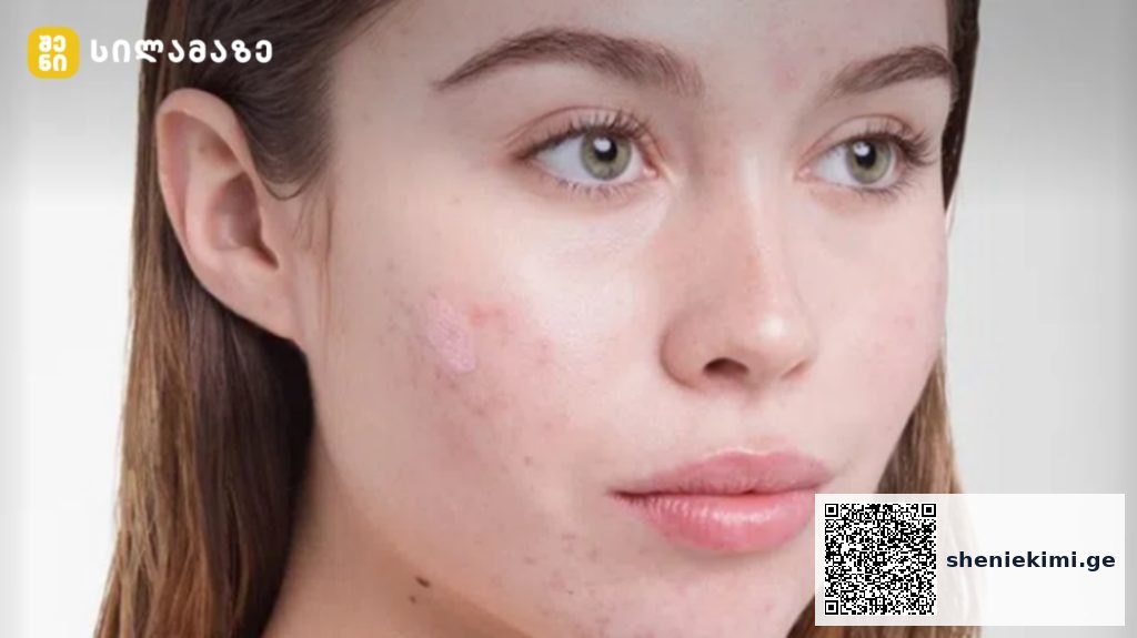 Close-up of a young woman's face with acne on her cheeks and a neutral expression.