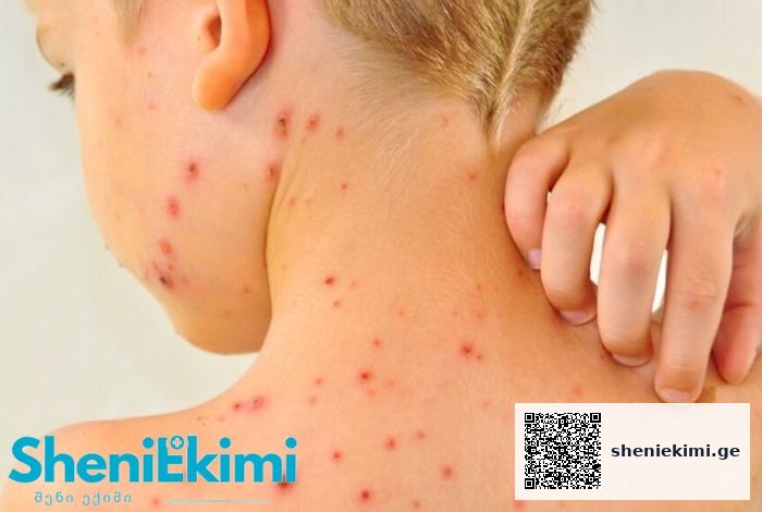 Close-up of a young person’s neck and upper back covered with red acne lesions; hand touching the skin; SheniKimi logo in corner.
