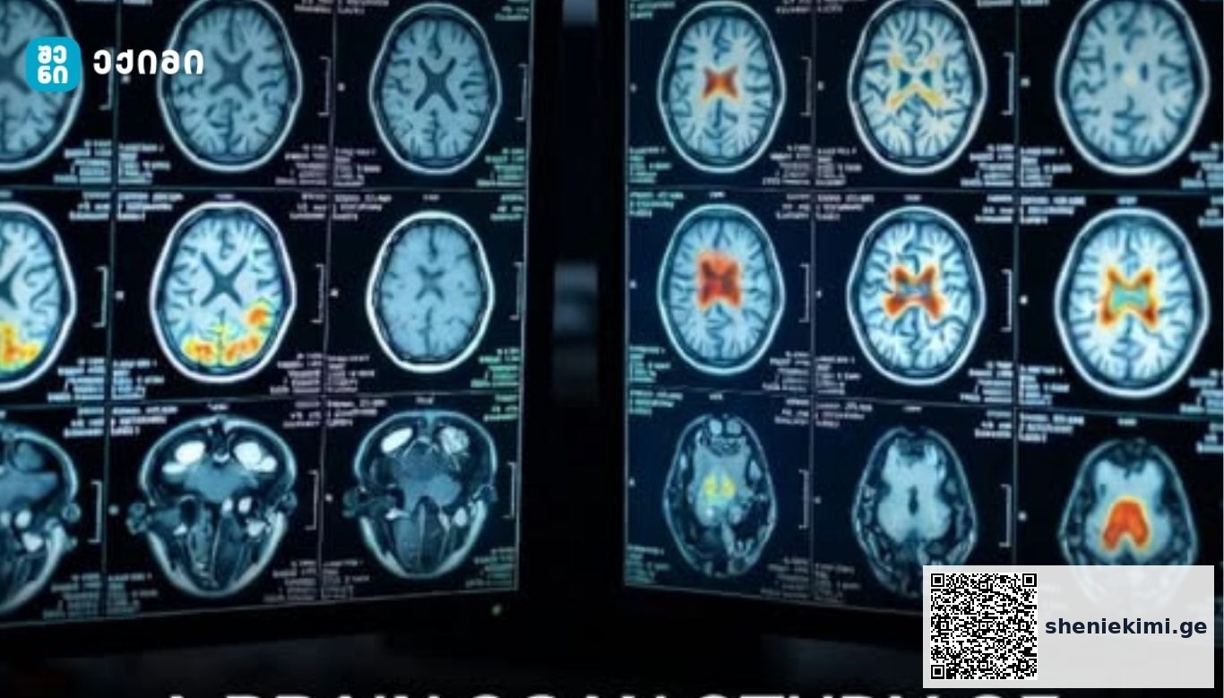 ADHD და ტვინი: მსოფლიოში ერთ-ერთმა ყველაზე დიდმა კვლევამ ნევროლოგიური განსხვავებების არსებობა დაადასტურა