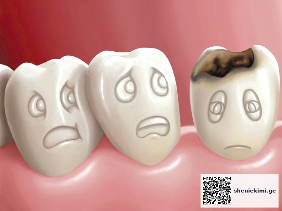 Row of molar teeth with cartoon faces looking worried, highlighting a tooth with a large cavity on the right.