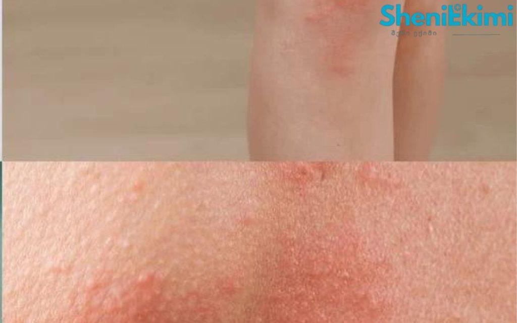 ჭინჭრის ციების უეცარი შეტევა – როგორ ვიმოქმედოთ სწორად? | sheniekimi.ge | შენი ექიმი