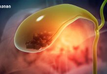 ქოლესტერინი და მისი ბუნებრივი რეგულაცია – 5 რჩევა ქოლეცისტიტი | ის, რაც უნდა ვიცოდეთ