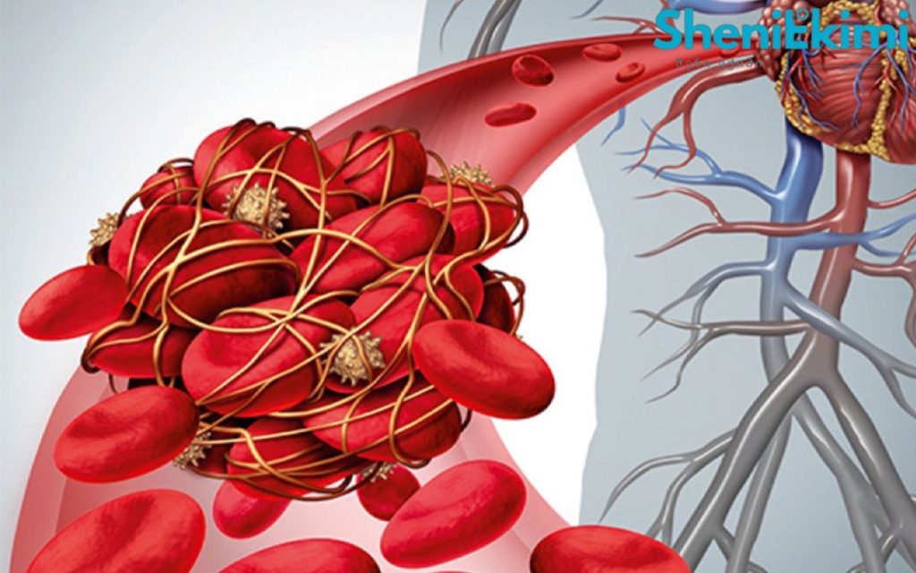 თავიდან ავიცილოთ გართულებები – თრომბის ნიშნები, რომლებიც უყურადღებოდ არ უნდა დავტოვოთ | sheniekimi.ge | შენი ექიმი