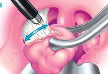 „მშობლები ხშირად მეკითხებიან: თუ ბავშვს დიდი გლანდები აქვს, აუცილებლად საჭიროებს ოპერაციას?“ – რას გვირჩევს ინგა მამუჩიშვილი რა ასაკიდან შეიძლება გლანდების ამოჭრა? როდის უნდა მიმართოთ სპეციალისტს?