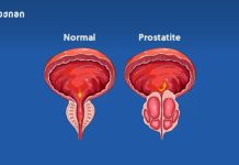 კეთილთვისებიანი პროსტატული ჰიპერპლაზია (BPH) – საინფორმაციო ბუკლეტი (მამაკაცის ჯანმრთელობა)