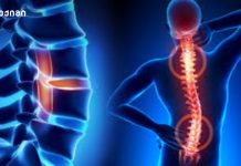 ოსტეოპოროზი – საინფორმაციო ბუკლეტი (ორთოპედია)