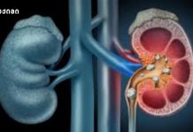 თირკმლის კიბოს გამაფრთხილებელი ნიშნები, რომელთა დროული ამოცნობა მნიშვნელოვანია თირკმლის დაავადებები დიაბეტის დროს