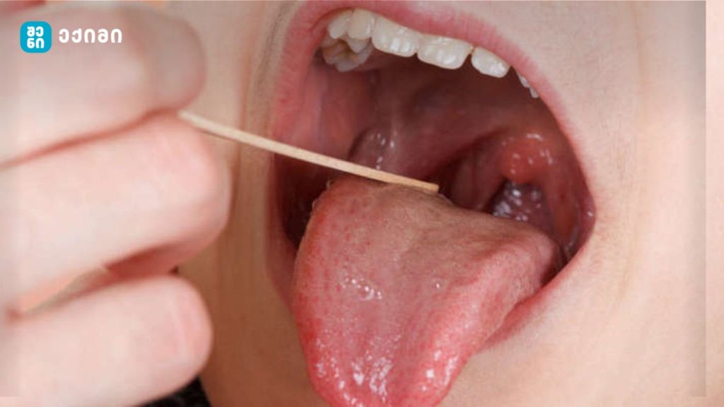 ტონზილექტომია და პოსტოპერაციული სისხლდენა: რა უნდა იცოდეთ გლანდების ამოკვეთის შემდეგ | sheniekimi.ge | შენი ექიმი კვლევა და შედეგები - ბავშვობაში გლანდების ამოჭრას შეიძლება დრამატული გავლენა ჰქონდეს ადამიანის ცხოვრებაზე