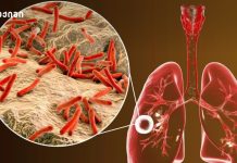 ტუბერკულოზის მართვის პროგრამის ბიუჯეტი ₾17 მლნ იქნება – მთავრობის დადგენილება გამოავლინე, უმკურნალე, განკურნე ტუბერკულოზი