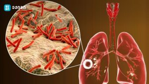 ტუბერკულოზის მართვის პროგრამის ბიუჯეტი ₾17 მლნ იქნება – მთავრობის დადგენილება