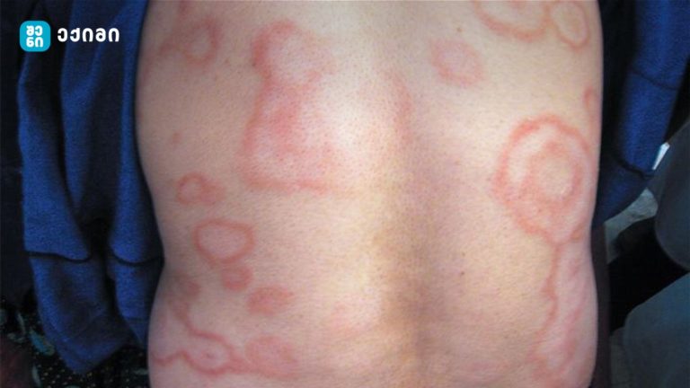 კეთრი (Leprosy) (ლეპრა, ჰანსენის დაავადება, ლომის სახე)