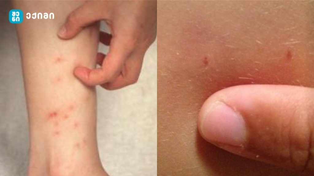 გიორგი ფხაკაძე მუნის მკურნალობის პროტოკოლს აქვეყნებს | sheniekimi.ge | შენი ექიმი „პაციენეტების მეორედი მუნის დიაგნოზით ტოვებს ჩემს კაბინეტს“ - რა უნდა გავაკეთოთ მუნის დიაგნოზის შემთხვევაში