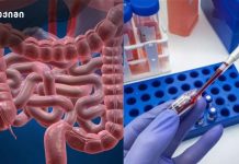 ნაწლავის ანთებითი დაავადება: ახალი პრეპარატი იმედია თუ ჯერ კიდევ კვლევის ეტაპი? ამ აღმოჩენამ, შესაძლოა, ნაწლავის ანთებითი დაავადების მქონე ადამიანების ცხოვრება შეცვალოს