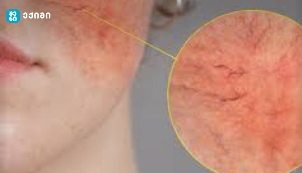 ყველაფერი სახის კანის შესახებ და რჩევები მის მოსავლელად – ქალბატონებო, არ დაიზაროთ თქვენი თავის მოვლა! | sheniekimi.ge | შენი ექიმი ყველაფერი სახის კანის შესახებ და რჩევები მის მოსავლელად – ქალბატონებო, არ დაიზაროთ თქვენი თავის მოვლა! | sheniekimi.ge | შენი ექიმი