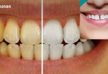 ძილში კბილების კრაჭუნი — ძირითადი მიზეზები კბილებს შორის სიცარიელე