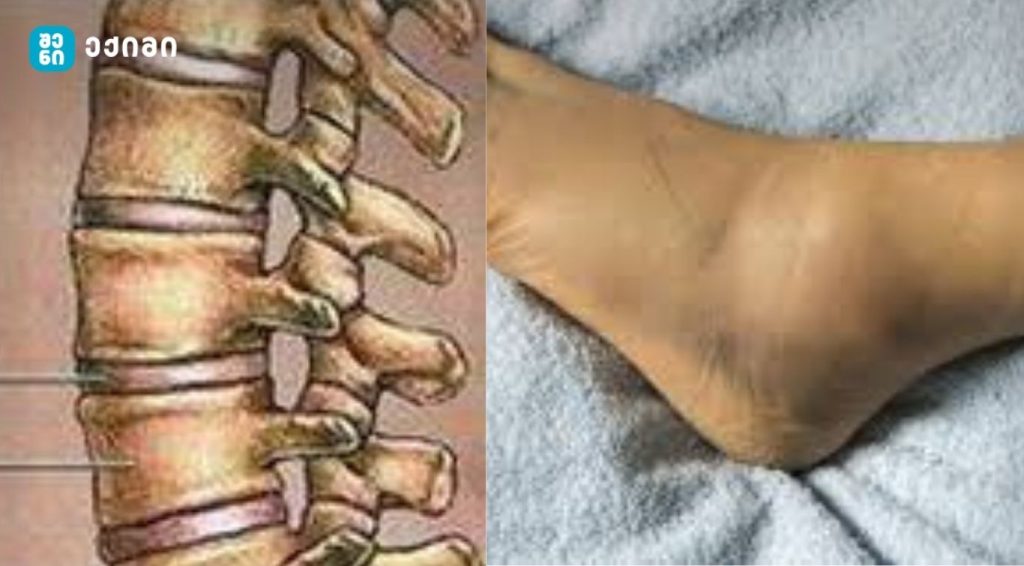 შეშუპება და დაბუჟება -ხერხემალი