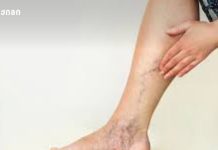 როგორ შევამჩნიოთ ვენების პრობლემები დროულად! ვარიკოზული დაავადება